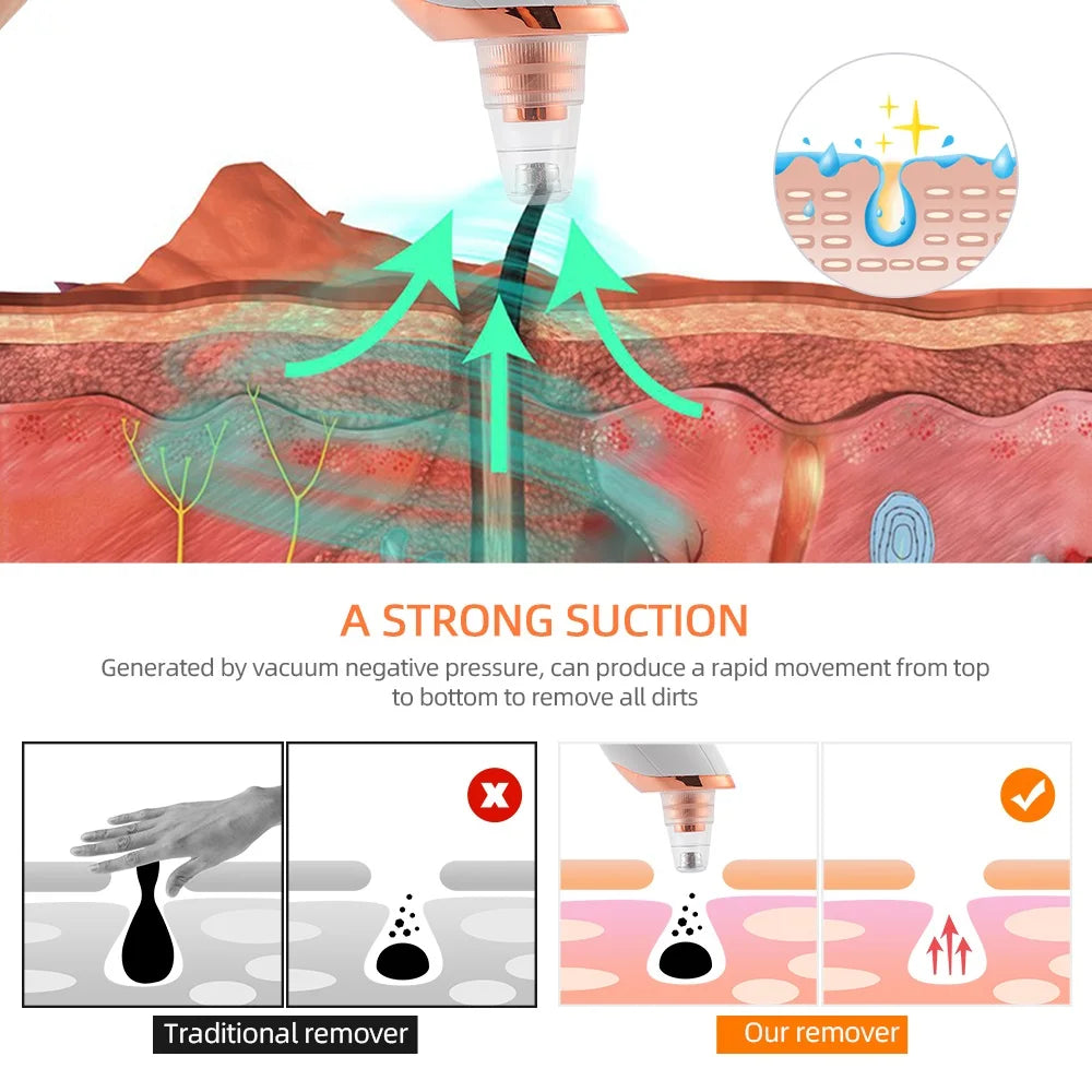 Facial Blackhead Vacuum Remover