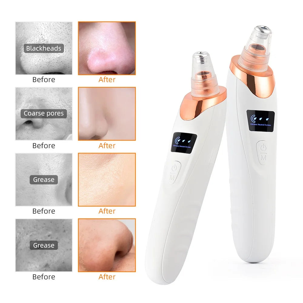 Facial Blackhead Vacuum Remover